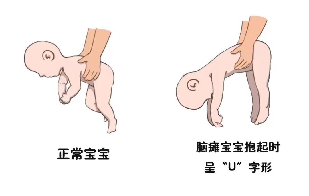 【健康科普】少儿脑瘫你应该了解这些（五）